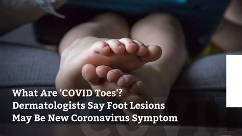 Unexpected COVID-19 infection symptoms include lesions on patients&x27; hands and feet, nausea, diarrhea, loss of smell, blood clots and confusion. . Sweaty feet symptom of covid